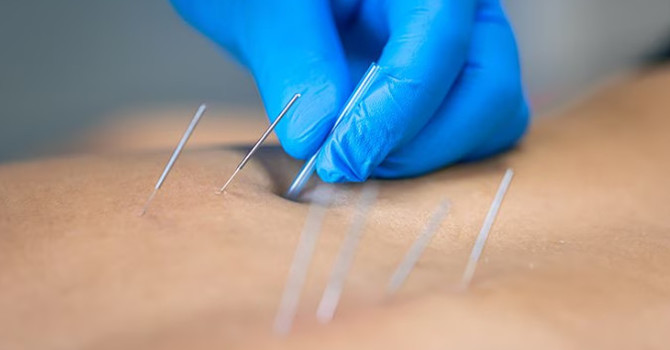 Acupuncture vs. Dry Needling: What's the Difference? image